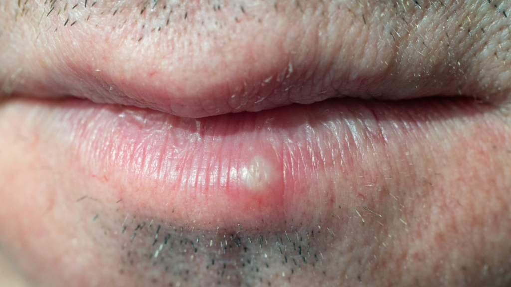 get rid of lip pimples