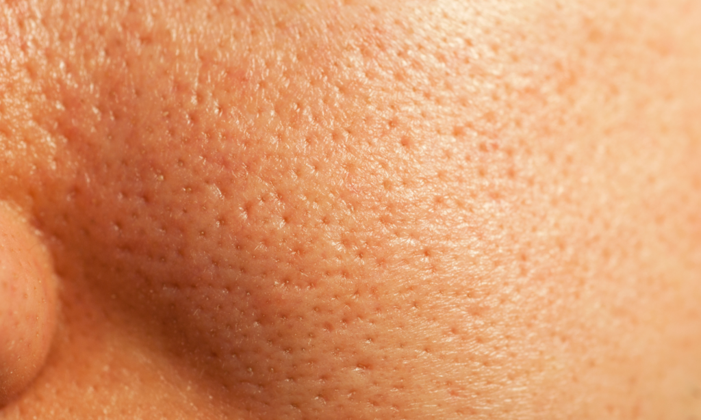 textured skin and large pores