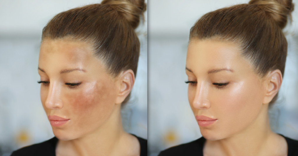 hyperpigmentation before and after