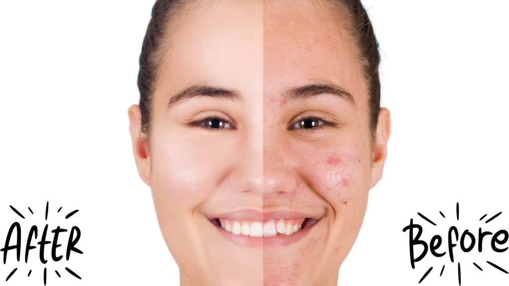 before and after using salicylic acid cleanser