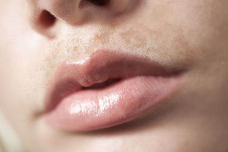 hyperpigmentation on upper lips