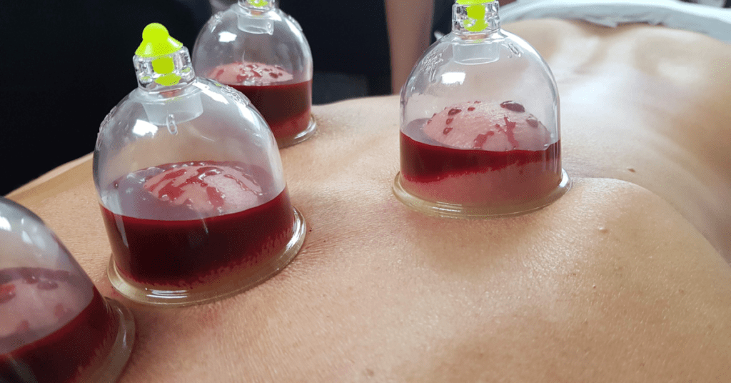 wet cupping therapy