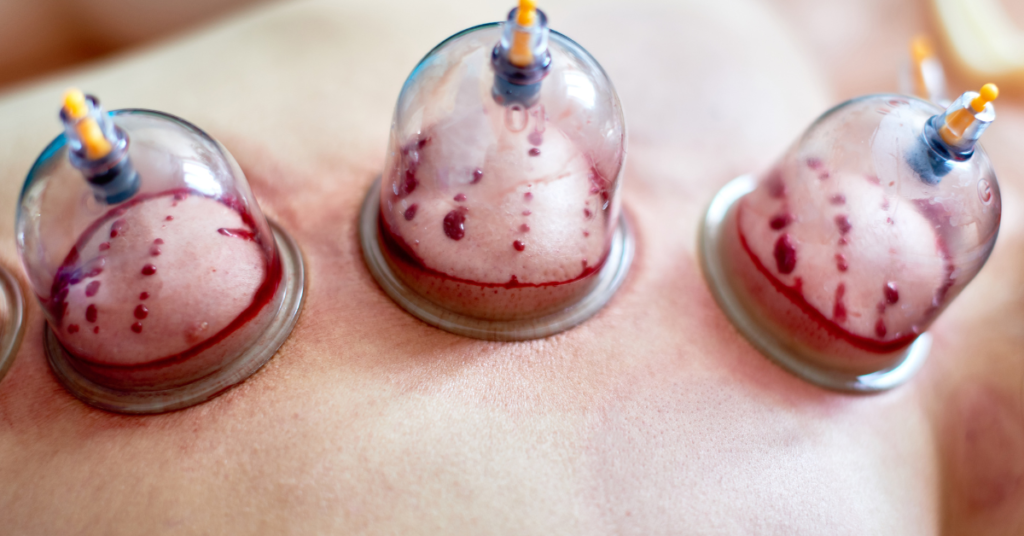 how to do cupping therapy